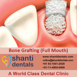 Dental Bone Grafting (full Mouth)