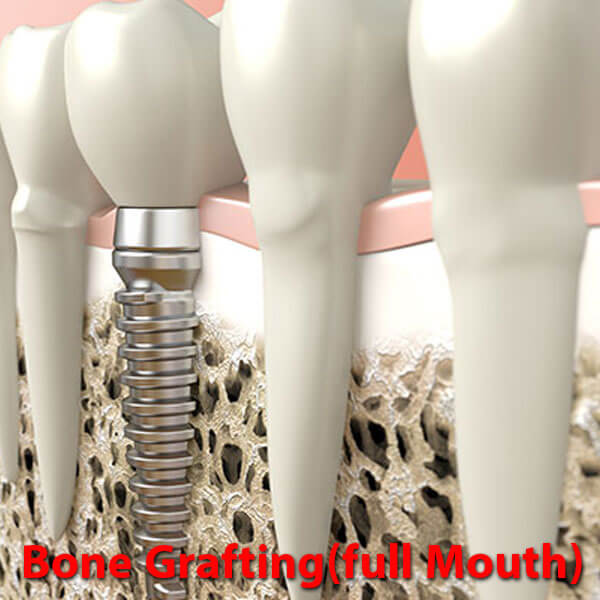Bone Grafting (full Mouth)