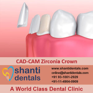 CAD-CAM Zirconia Crown