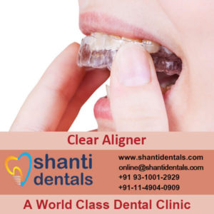 Dental Clear Aligner
