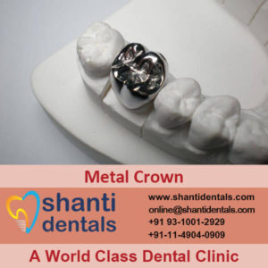 Dental Metal Crown