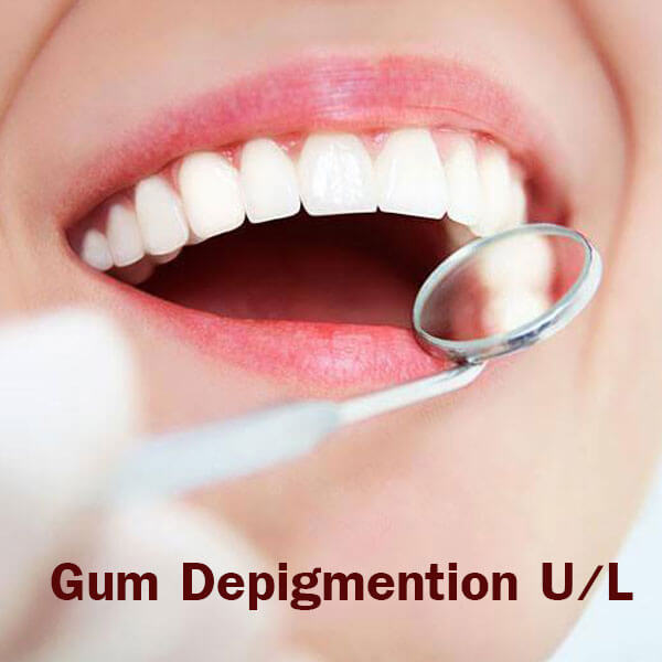 Gum Depigmention Both U/L