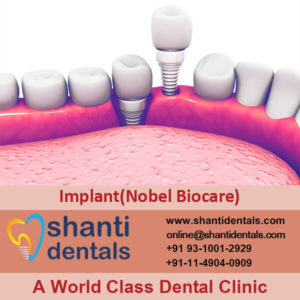 Dental Implant (Nobel Biocare)