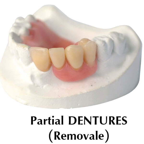 Partial Dentures (Removale)