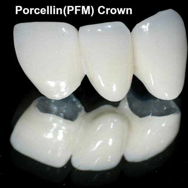 Porcellin(PFM) Crown