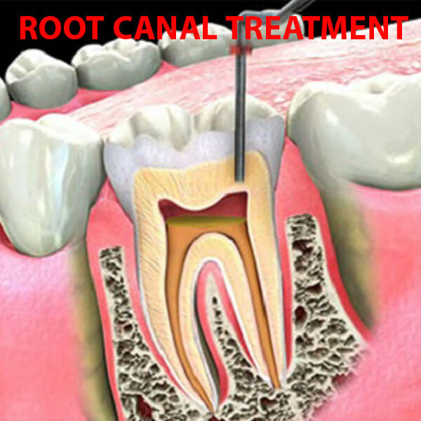 Root Canal Treatment