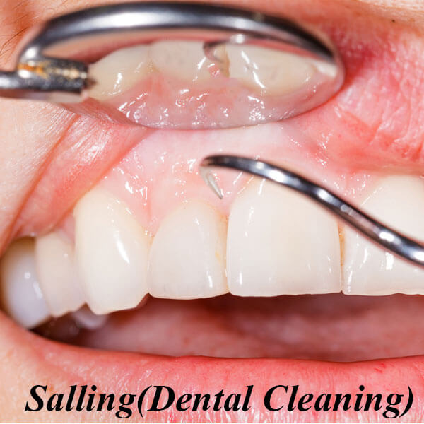 Salling (Dental Cleaning)