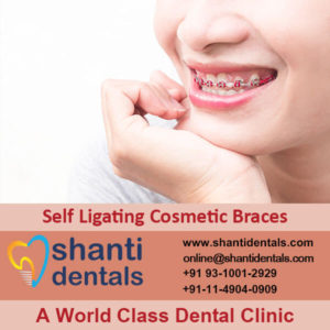 Self Dental Ligating Cosmetic Braces