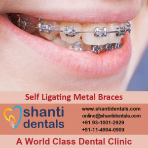 Self Ligating Dental Metal Braces