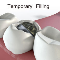 Temporary Filling