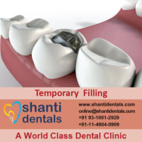 Dental Temporary Filling