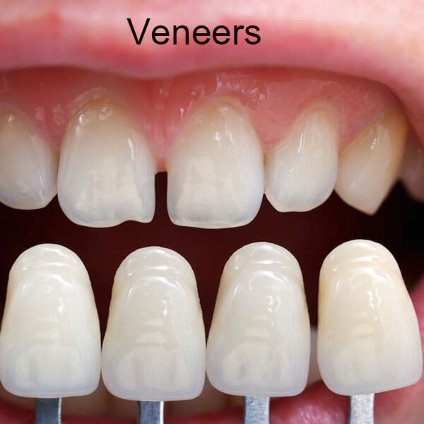 Veneers