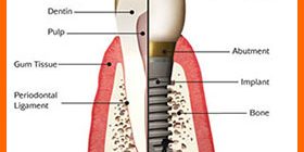 dental-implant-by-shanti-dentals