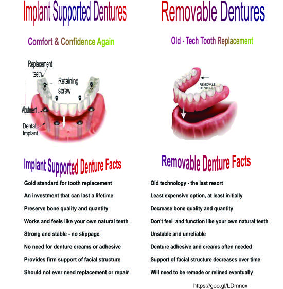10 Benefits of Dental Implants by shanti dentals