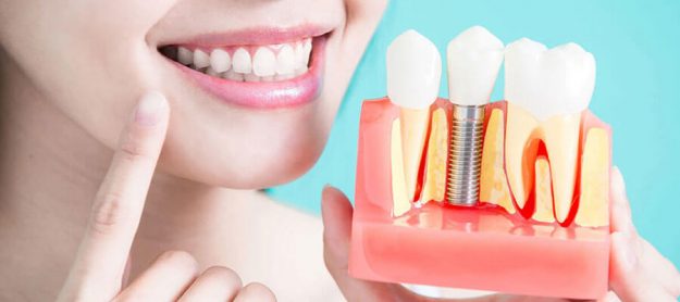 Replace your Missing Teeth with Dental Implant by shanti Dentals
