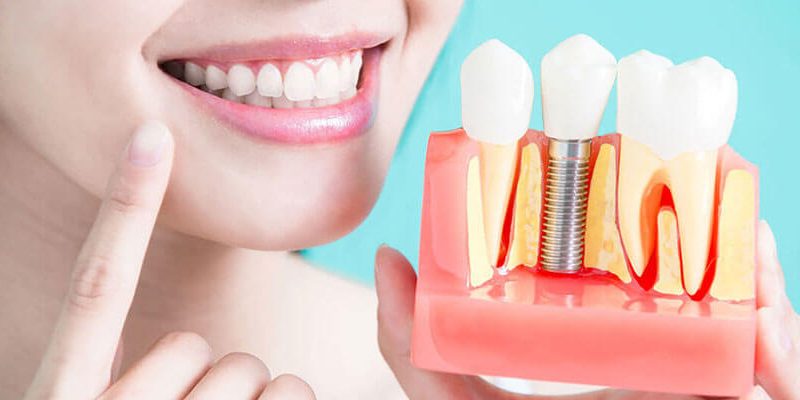 Replace your Missing Teeth with Dental Implant by shanti Dentals Replace your Missing Teeth with Dental Implant by shanti Dentals