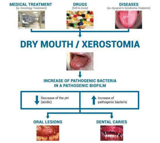 Ultimate Facts About Oral Health in Dry Mouth