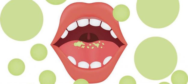 Ultimate Facts About Oral Health in Dry Mouth Treatment by shanti Dentals