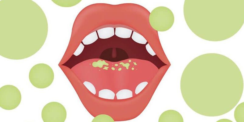 Ultimate Facts About Oral Health in Dry Mouth - Shanti Dentals