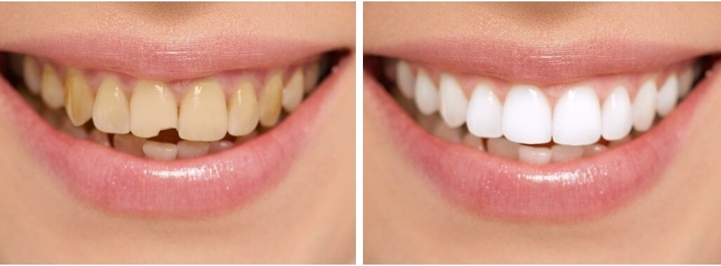 Smile-Makeover-by-shanti-dentals