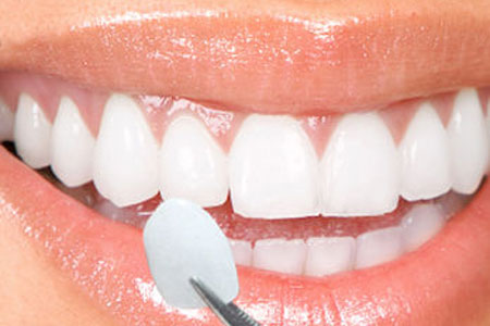 porcelain veneers