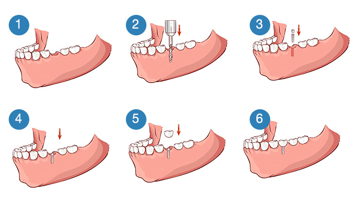 Dental Implant Surgery