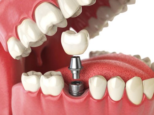 Prosthodontics & Dental Implant in Delhi