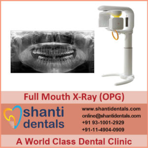 Full Mouth X-Ray (OPG)