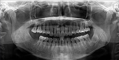 Full Mouth X-Ray (OPG)