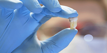 Simple Tooth Extraction