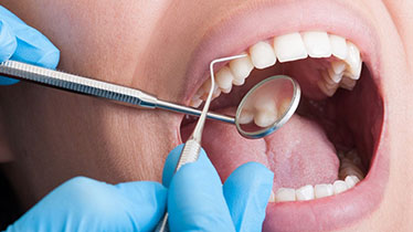 Dental Scaling Treatment