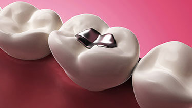 How Cavity Fillings work