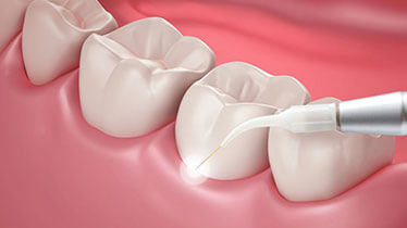 Laser Dentistry Treatment