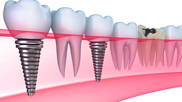 Dental Implant Services with Latest Advanced Technology in Rohini, Delhi
