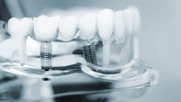 Best Dental Implants in Rohini, Delhi
