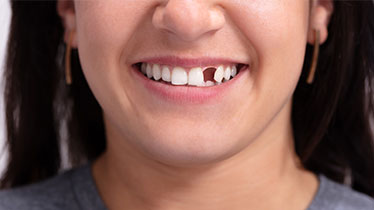 How Do We Replace The Missing Teeth?