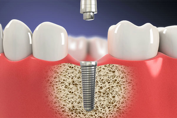 Treating Dental Implant Infection: Effective Solutions and Care