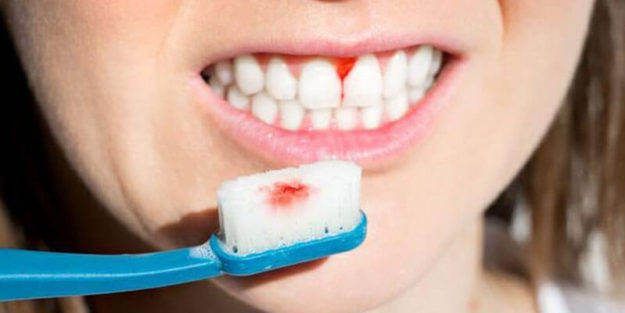 Paria (Pyorrhea) in teeth | Know About Case and Treatment