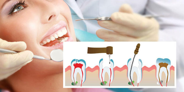 Root Canal Treatment for Chipped Tooth