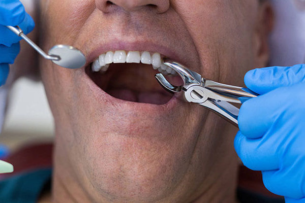 Wisdom Teeth Removal Recovery Tips to Faster Healing