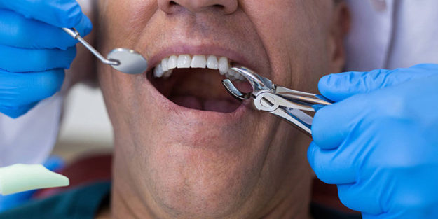 Wisdom Teeth Removal Recovery Tips to Faster Healing