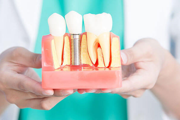 7 Important Things You Don't Know About Dental Implants