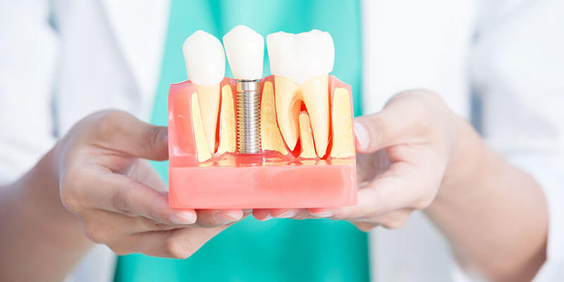 7 Important Things You Don't Know About Dental Implants