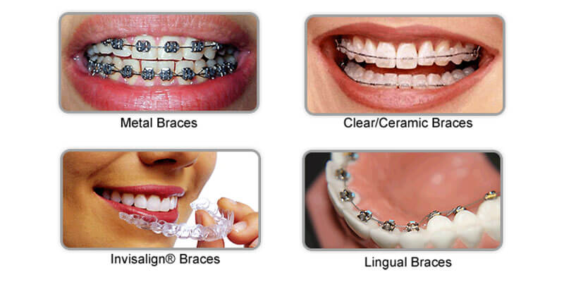 Choosing Which Type of Braces Are Best for You
