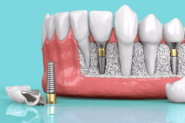 benefits-of-dental-implats
