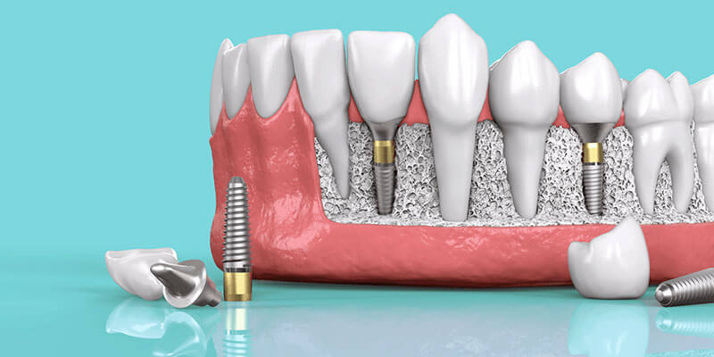 benefits-of-dental-implats