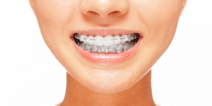 clear-braces-is-improve-a-smile-on-your-face clear-braces-is-improve-a-smile-on-your-face