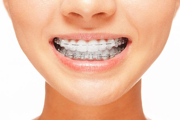 clear-braces-is-improve-a-smile-on-your-face