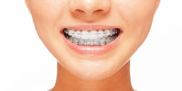 clear-braces-is-improve-a-smile-on-your-face