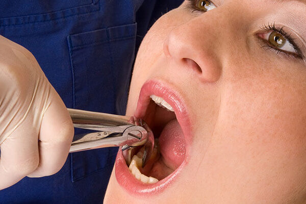 What are the Benefits of Root Canal Treatment ?